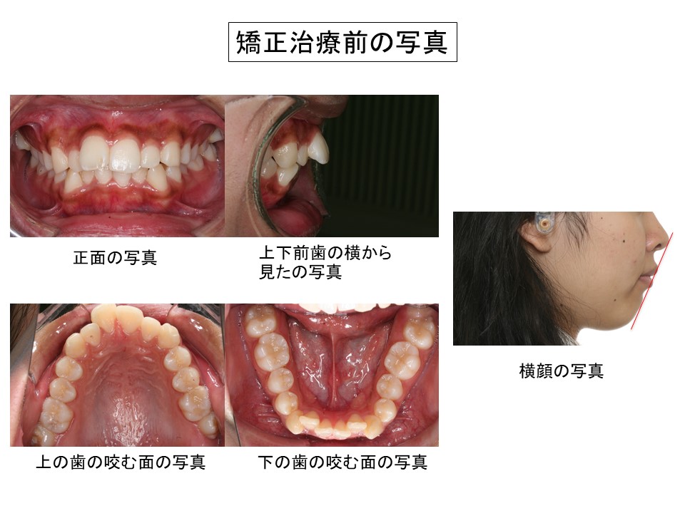 永久歯の叢生について|宮崎台おとなこども矯正歯科(川崎市宮前区) |
